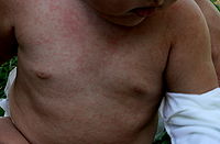 Foto zu  Kinderkrankheiten von A-Z: 3-Tage-Fieber
